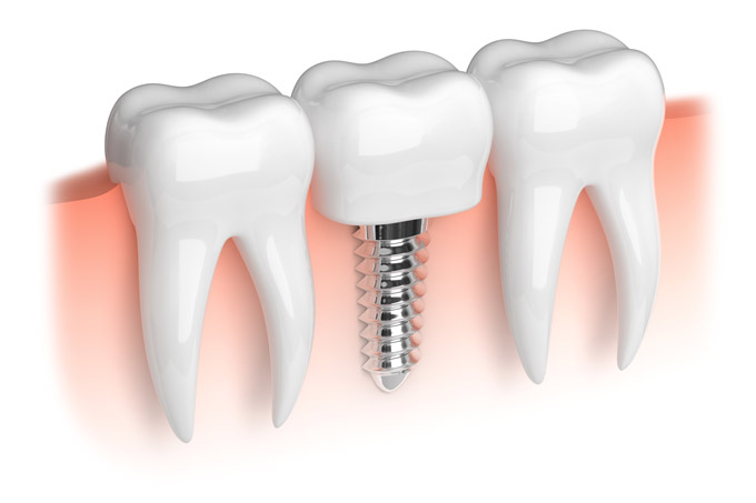 Implant Instructions